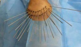 银质针视频,揭秘古老针法的现代应用与疗效